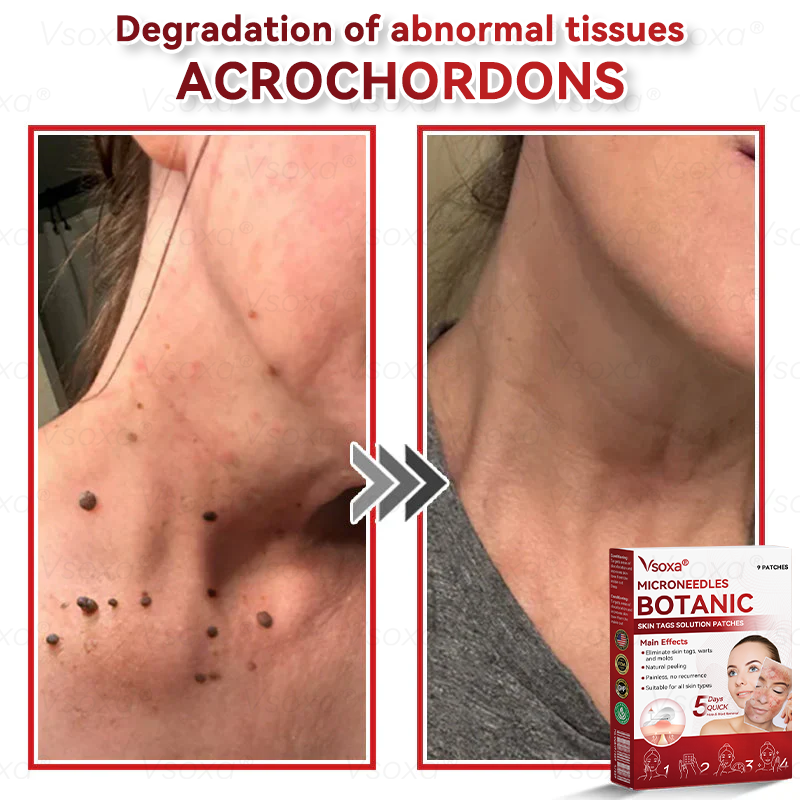 ๐๐ ๐๐ฅ๐ยฎ๐งMicroneedles Botanical Skin Tags Solution Patches - Made in the USA๐ฉโโ๏ธ
