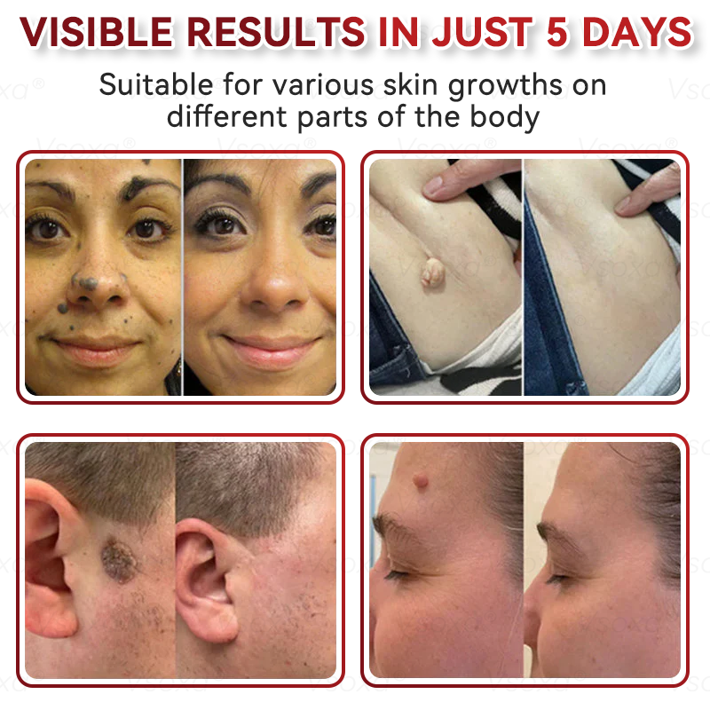 𝑉𝑠𝑜𝑥𝑎®💧Microneedles Botanical Skin Tags Solution Patches - Made in the USA👩‍⚕️