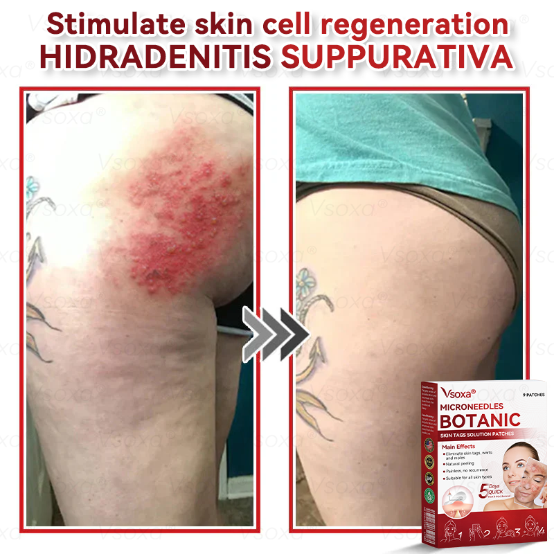 𝑉𝑠𝑜𝑥𝑎®💧Microneedles Botanical Skin Tags Solution Patches - Made in the USA👩‍⚕️