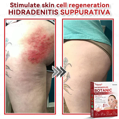 𝑉𝑠𝑜𝑥𝑎®💧Microneedles Botanical Skin Tags Solution Patches - Made in the USA👩‍⚕️