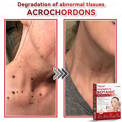 𝑉𝑠𝑜𝑥𝑎®💧Microneedles Botanical Skin Tags Solution Patches - Made in the USA👩‍⚕️