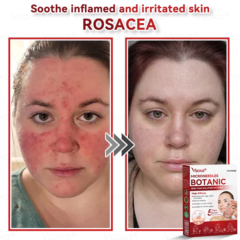 𝑉𝑠𝑜𝑥𝑎®💧Microneedles Botanical Skin Tags Solution Patches - Made in the USA👩‍⚕️