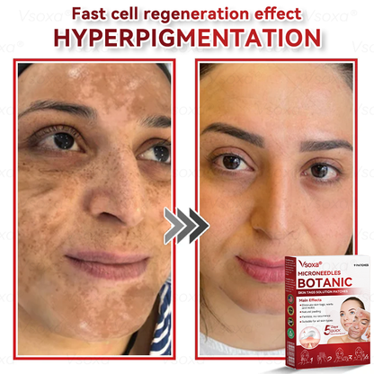𝑉𝑠𝑜𝑥𝑎®💧Microneedles Botanical Skin Tags Solution Patches - Made in the USA👩‍⚕️